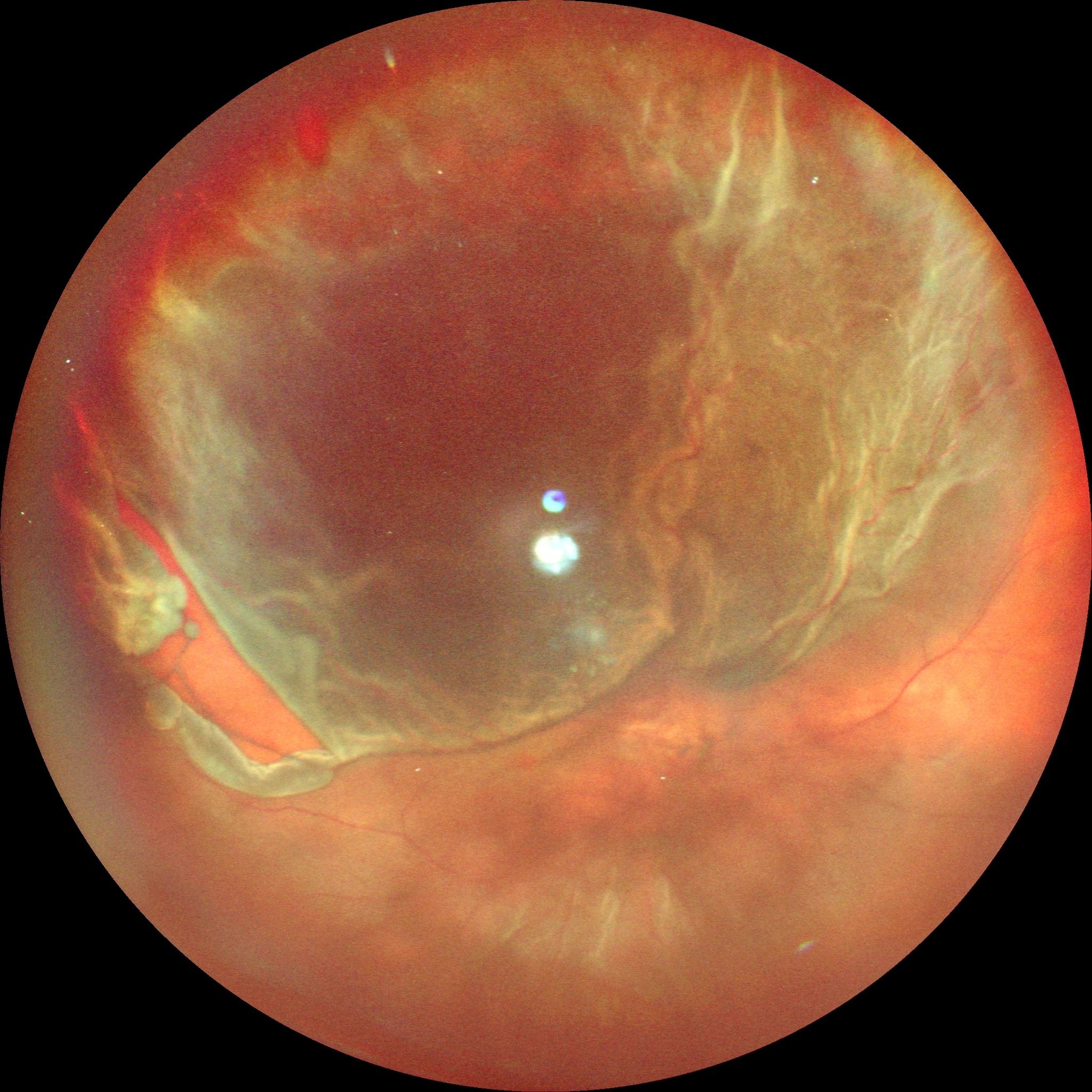 Preoperatif büyük yırtıklı büllöz retina dekolmanı